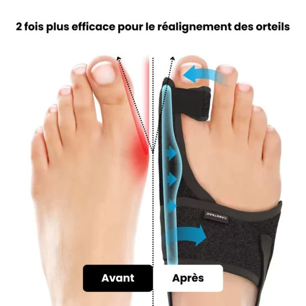 CASE HALLUX VALGUS DE NUIT GOUCHE ADULTE